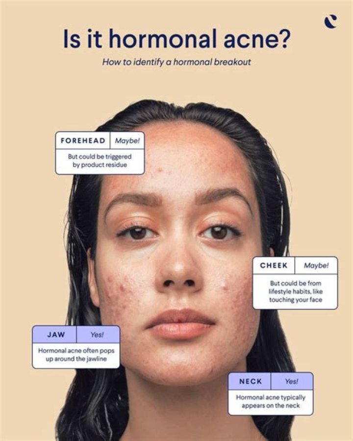 Acne Diet – Attain Beautiful and Flawless Skin